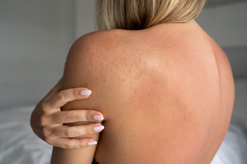 Soleksem och känslighet